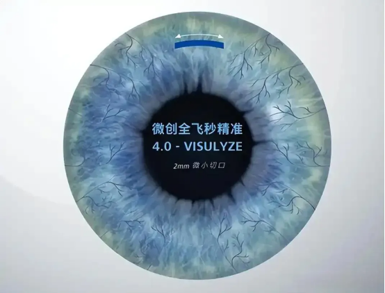 沈阳普瑞眼科丨全飞秒近视手术究竟适不适合你呢？看了就知道了！