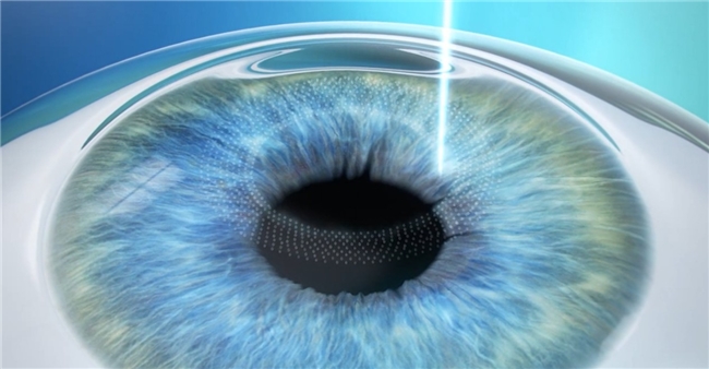 沈阳普瑞眼科丨备受追捧的全飞秒近视手术究竟适不适合你呢？