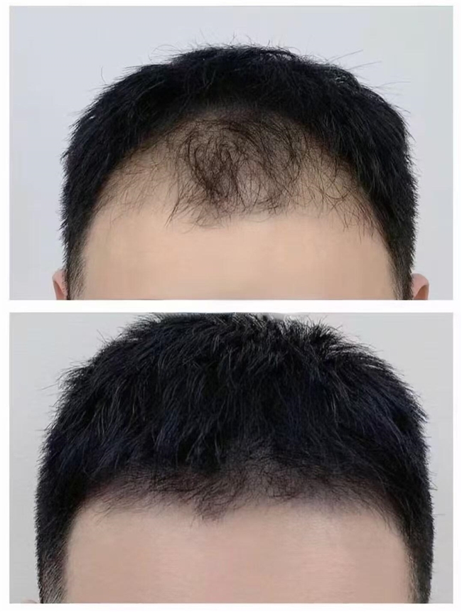 脂溢性脱发买哪个牌子的育发液效果好?口碑好的10款防脱生发液品牌推荐 脂溢性脱发买哪个牌子的育发液效果好?口碑好的10款防脱生发液品牌推荐