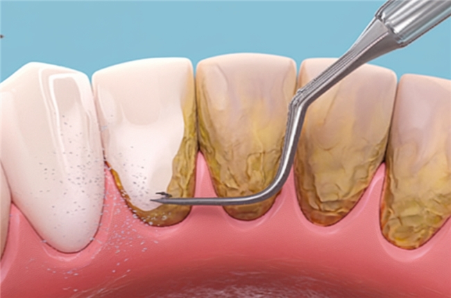 洗牙全科普：清除牙石，守護口腔健康的基礎護理
