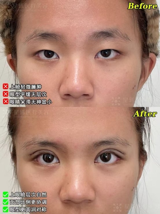 临沂双眼皮怎么选？从审美标准、手术细节与术后护理解析(图1)