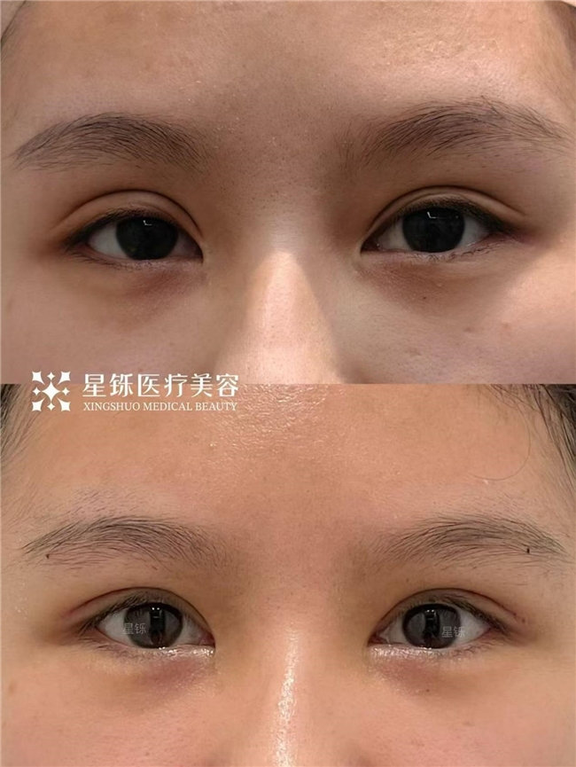临沂双眼皮怎么选？从审美标准、手术细节与术后护理解析(图3)