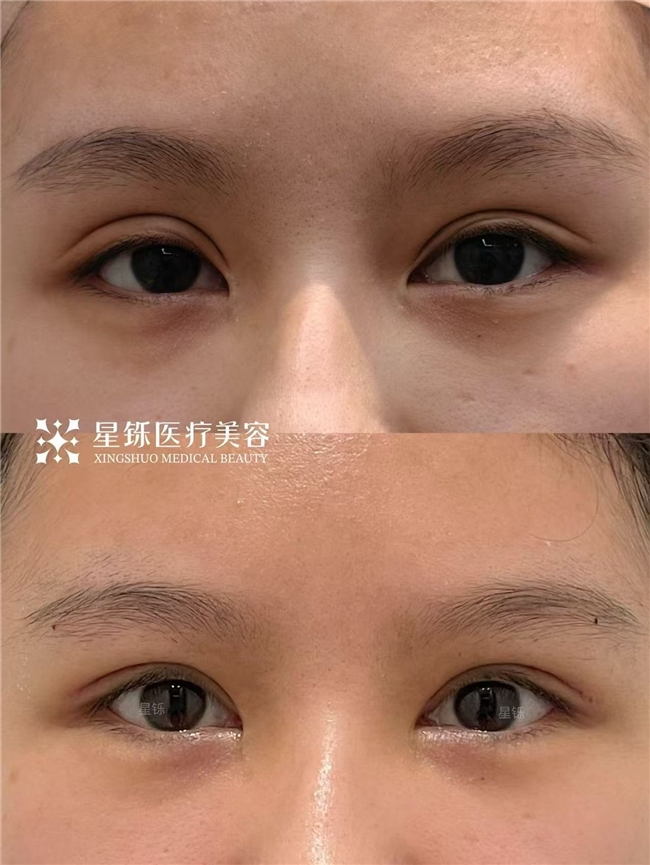 临沂双眼皮怎么选(图3) 临沂双眼皮怎么选(图3)